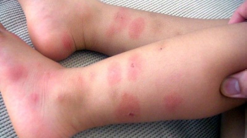 Как выглядят следы от укусов постельных клопов на теле у детей, какие симптомы их сопровождают?