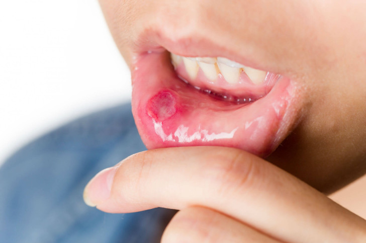 Как лечить белые и красные язвочки у ребенка во рту: медикаментозные средства и домашние рецепты