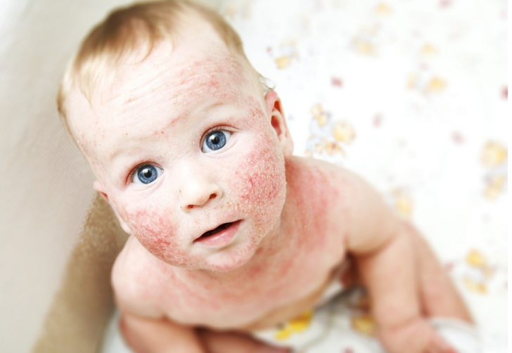 Атопический дерматит у ребенка средства для увлажнения кожи, лечение народной медициной