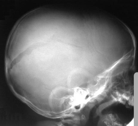 рентген при переломе черепа