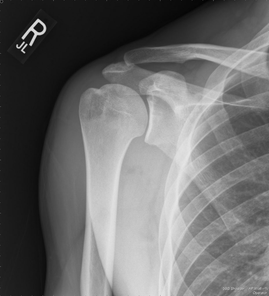 Рентген плечевой кости