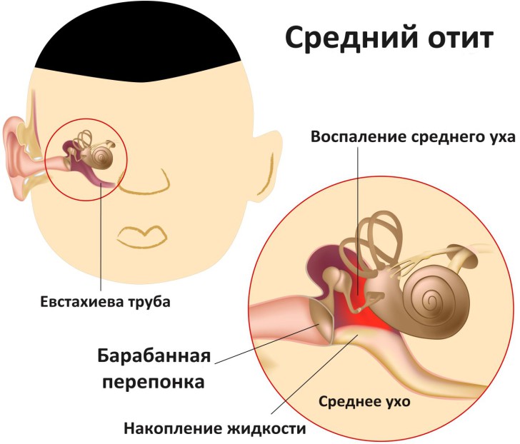 Симптомы и виды отита у детей, первая помощь и лечение воспаления уха в домашних условиях