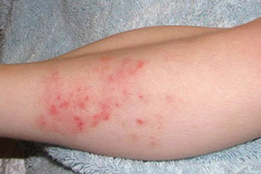 Проявление дерматита на ноге