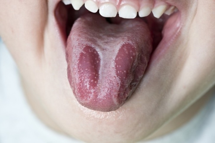 Причины появления прыщиков и сыпи на языке у ребенка белого и красного цвета