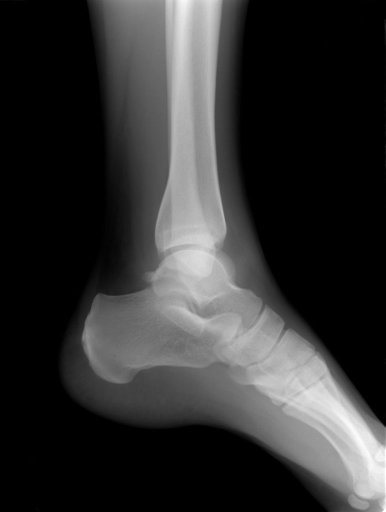 Рентген лодыжки - необходимость для диагностики перелома