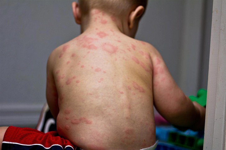Симптомы розеолы у детей: фото сыпи на начальной стадии, лечение и профилактика трехдневной лихорадки