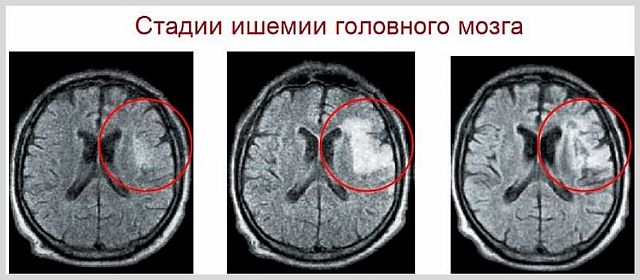 Хроническая ишемия (ишемическая атака) головного мозга