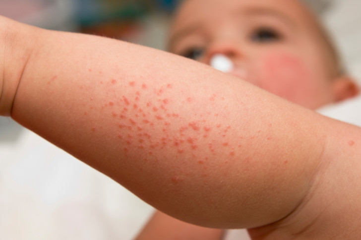 Виды сыпи у ребенка на ногах и ступнях с фото и пояснениями: признаки аллергии и инфекционных заболеваний