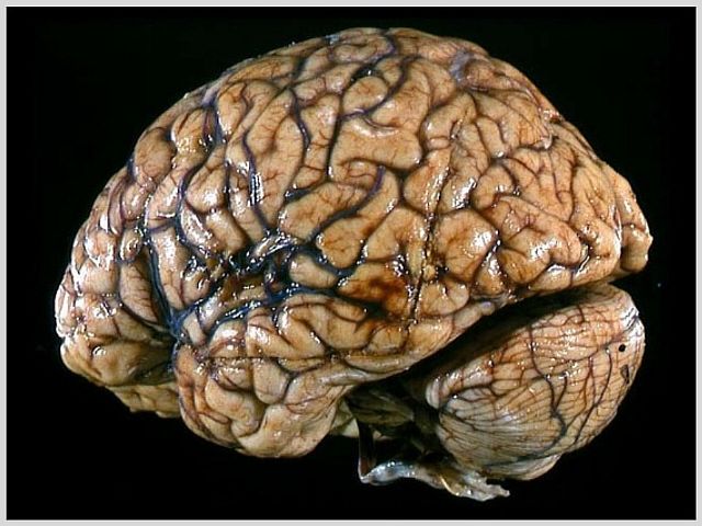 Отмирание клеток головного мозга (атрофические изменения) - что это такое