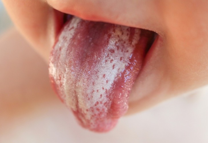 Кандидозный стоматит полости рта у детей: фото и способы лечения грибка