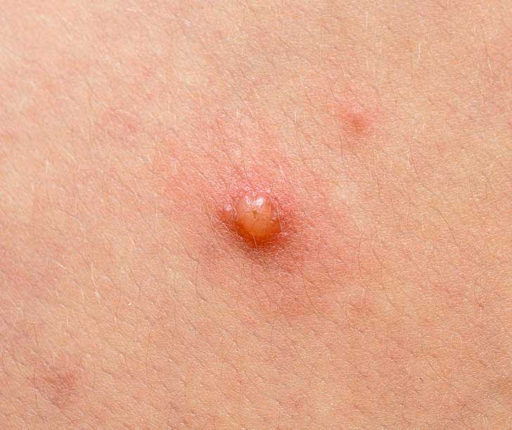 stock-photo-chickenpox-single-blister-at-early-stage-closeup-614716301