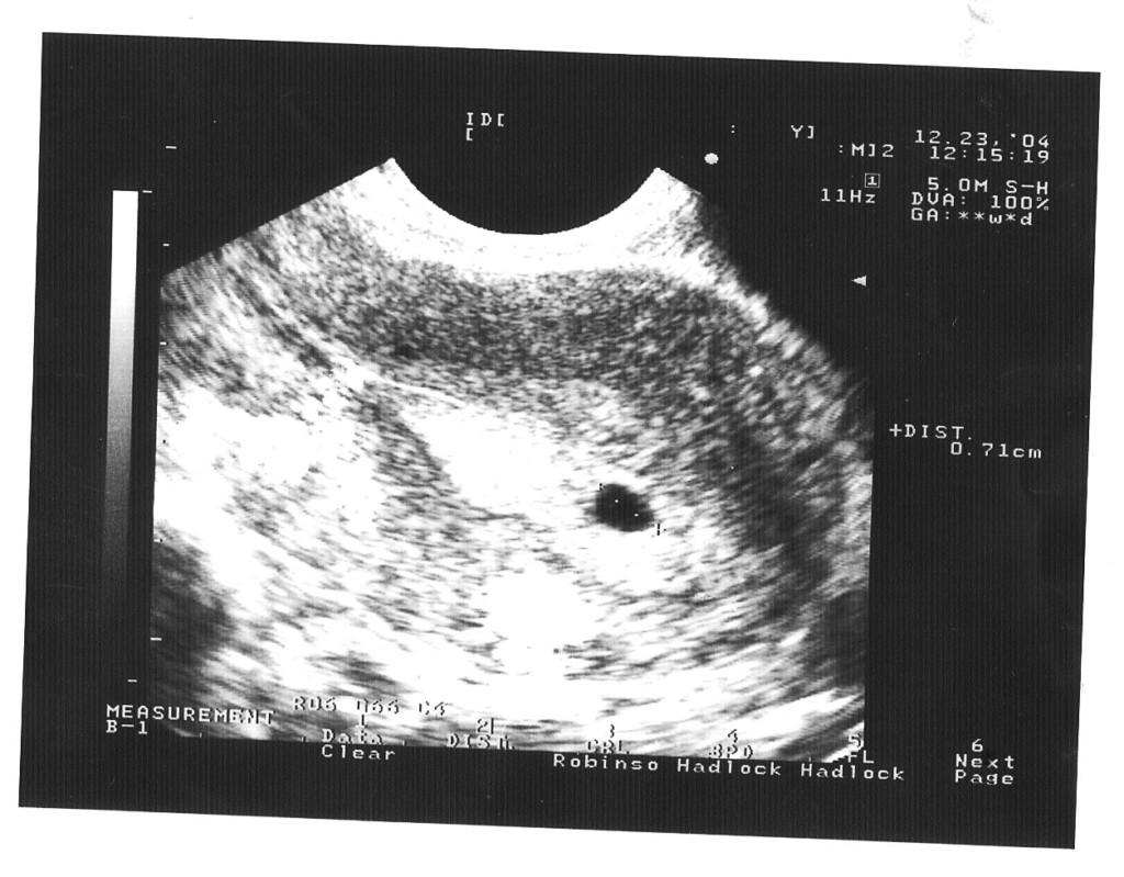 Что покажет УЗИ в 2 недели беременности, можно ли на фото увидеть эмбрион?