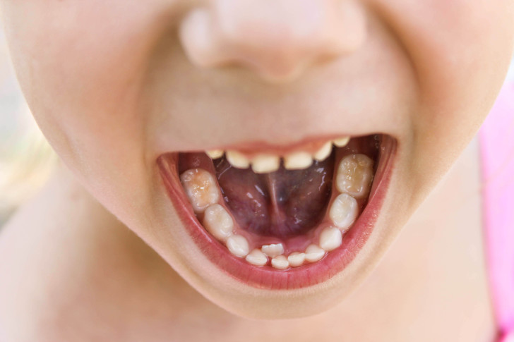 Показания к удалению молочного зуба ребенку: больно ли это и будут ли последствия?