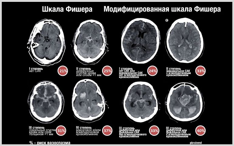 Последствия субарахноидального кровоизлияния головного мозга