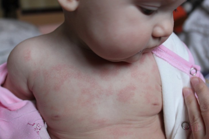 Как выглядит аллергия на лице грудничка: фото сыпи, симптомы и способы лечения