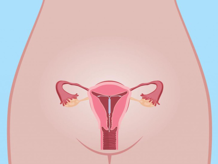Спирали внутриматочные для предотвращения беременности: плюсы и минусы, виды контрацептива, принцип работы и установка