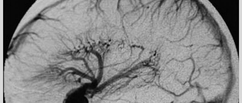 Признаки венозной ангиомы. Ангиома сосудов головного. Голова медузы венозная ангиома. Ангиома головного мозга мкб 10 венозная. Венозная ангиома теменной доли слева.